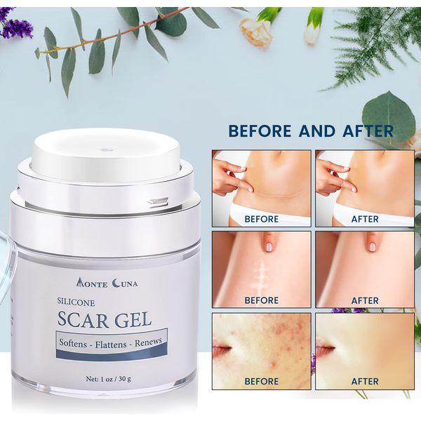 MONTE LUNA Scar Cream, Silicone Scar Gel - Scar Removal and Treatment Cream for Keloids, C-Section, Burn, Surgery, Acne - Physician Formulated Silicone Without Water. Effective for Old and New Scar 2
